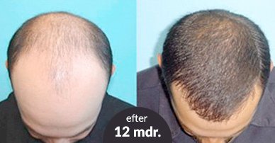 Billig billig hårtransplantation før og efter